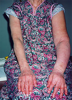 arm lymphedema patient after treatment