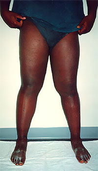 patient with leg lymphedema after treatment