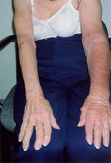 Arm Lymphedema After Treatment