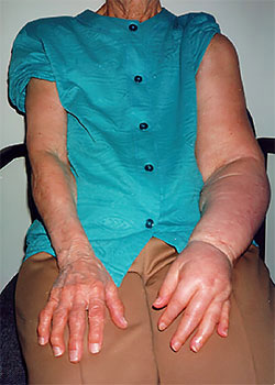 arm lymphedema patient before treatment