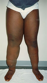 patient with leg lymphedema before treatment