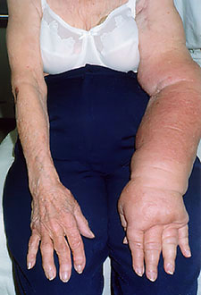 Arm Lymphedema Before Treatment
